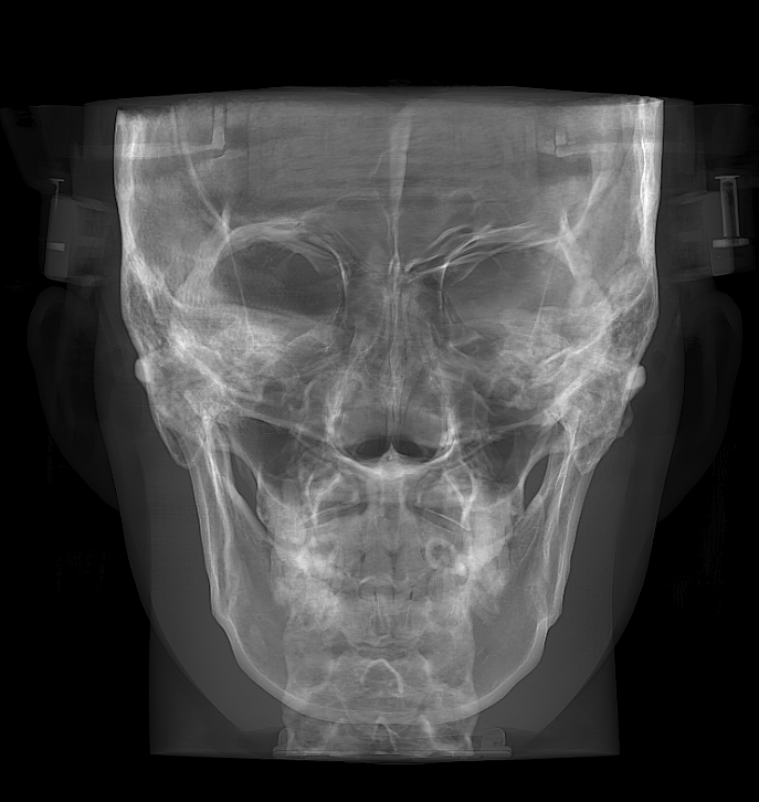 Frontal full cephalometric view