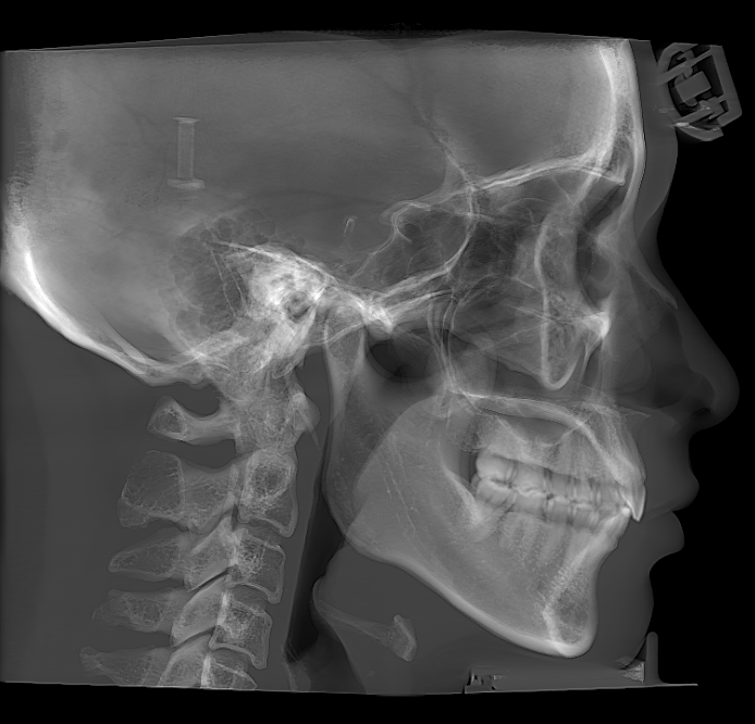 Lateral full cephalometric view