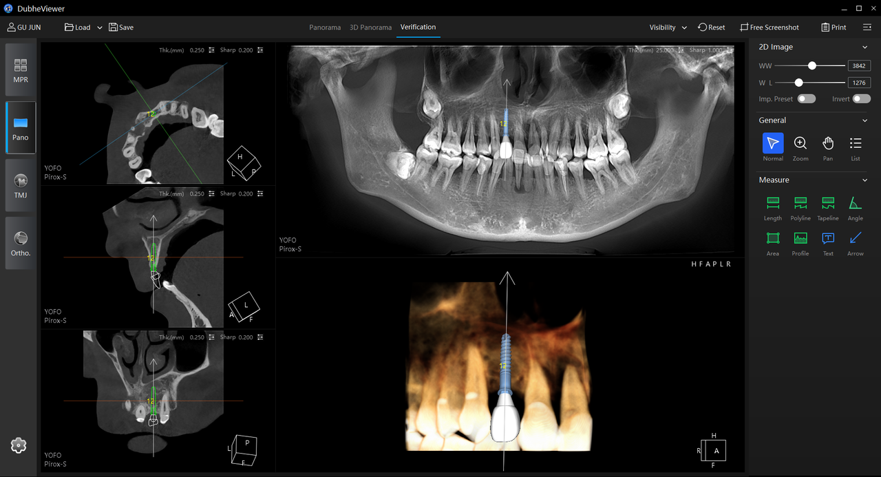 Implant plan validation interface