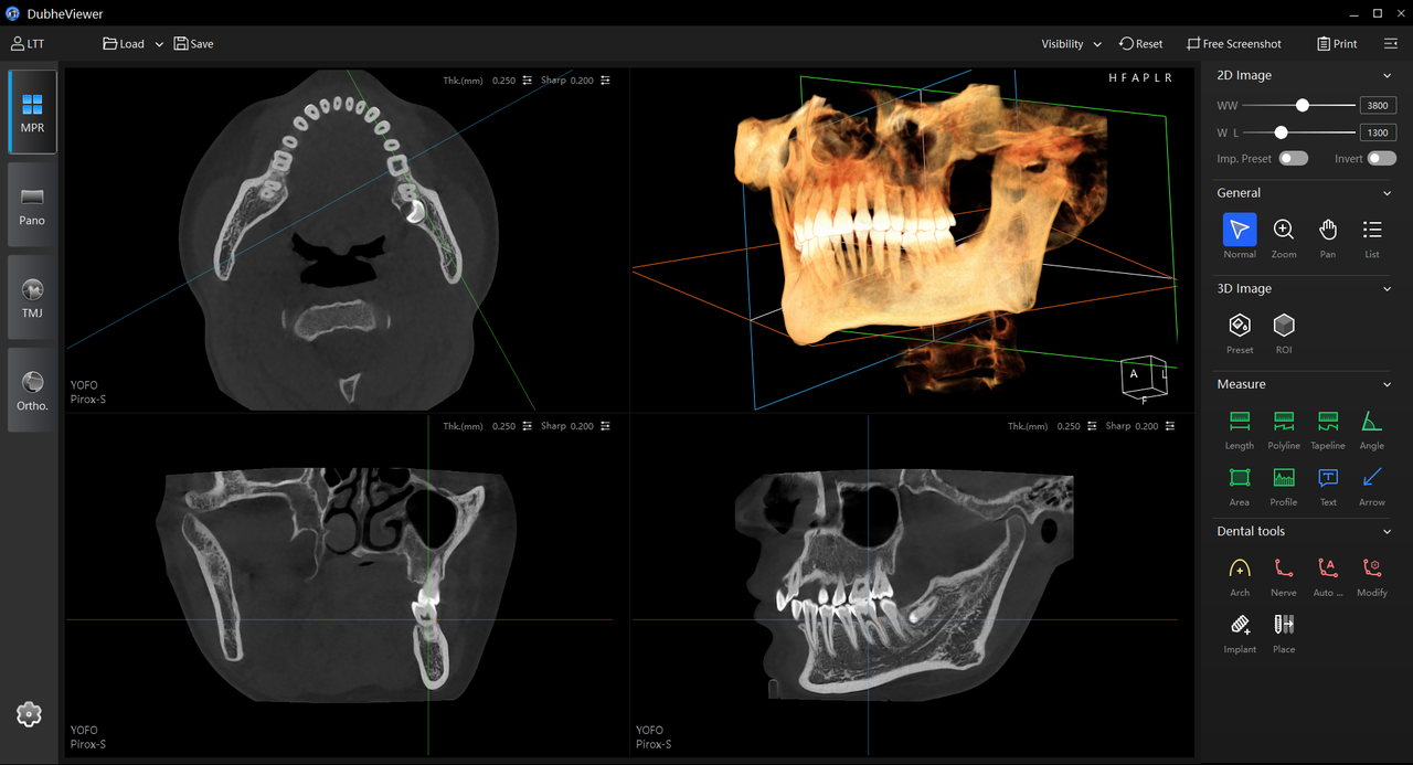 Sagittal MPR view