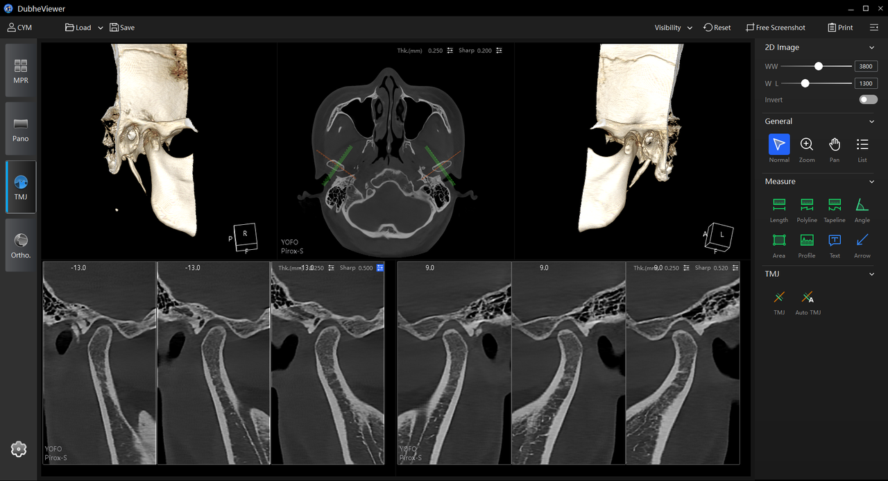 3D TMJ visualization