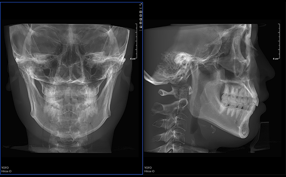 3D Frontal and Lateral