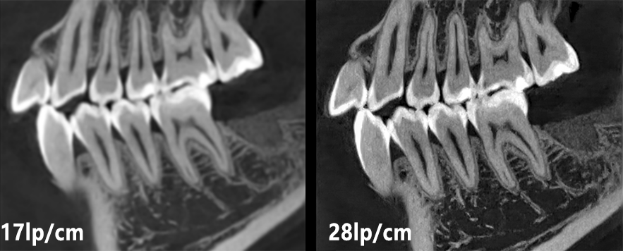Comparison of CBCT spatial resolution at 17 lp/cm and 28 lp/cm, showing finer image detail at 28 lp/cm.