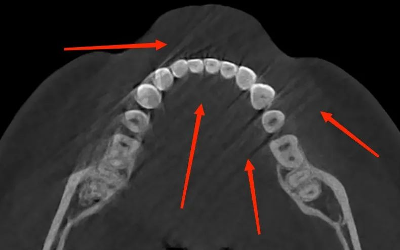 Dental CBCT image showing diagonal streak artifacts caused by sudden patient movement during scanning.