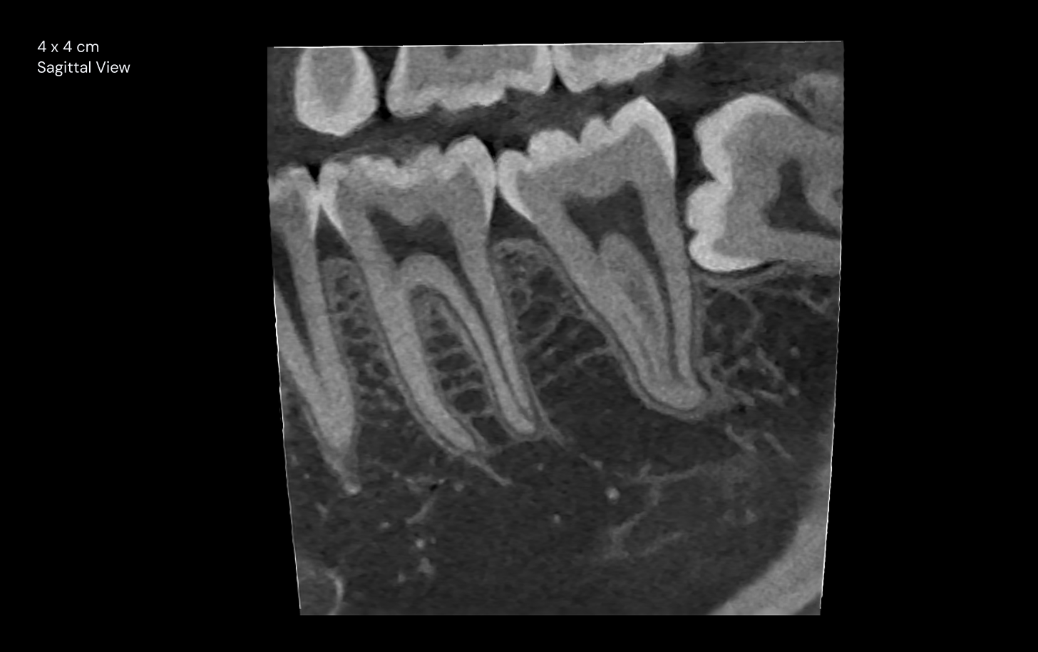 4 x 4 cm sagittal view